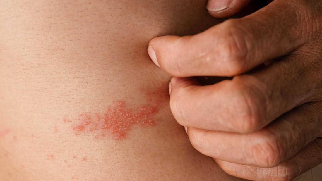 Skin rash and blistering due to shingles on abdomen, medical condition, skin disease.